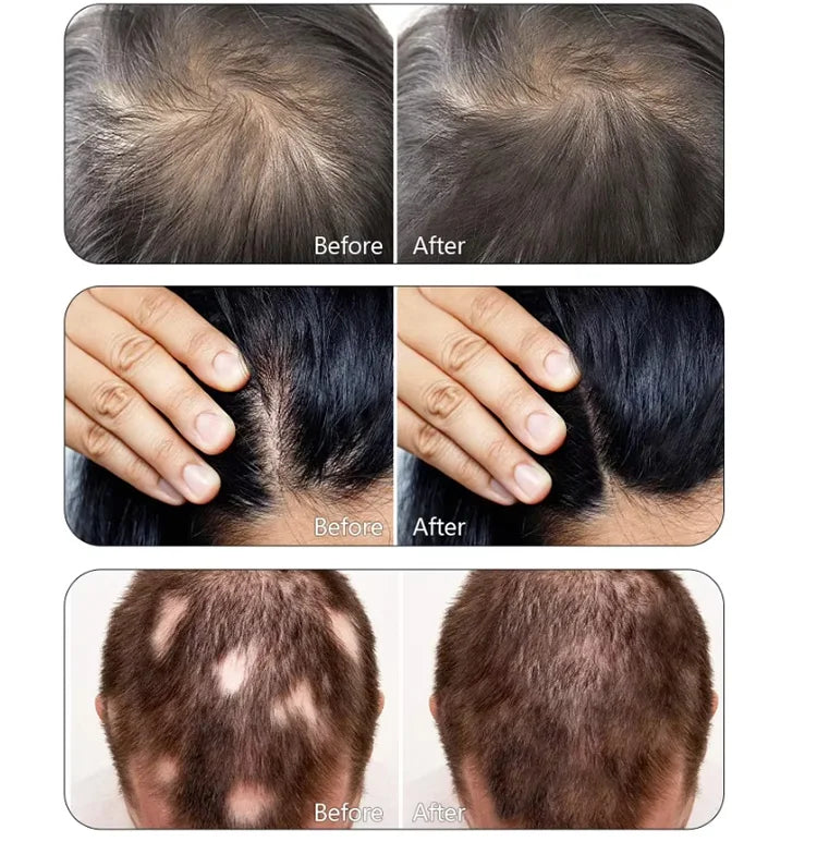 Tratamiento eléctrico multifuncional 650nm de luz roja para el crecimiento del cabello, anticaída, máquina para el crecimiento capilar, masaje para el cuidado del cuero cabelludo, crecimiento del cabello