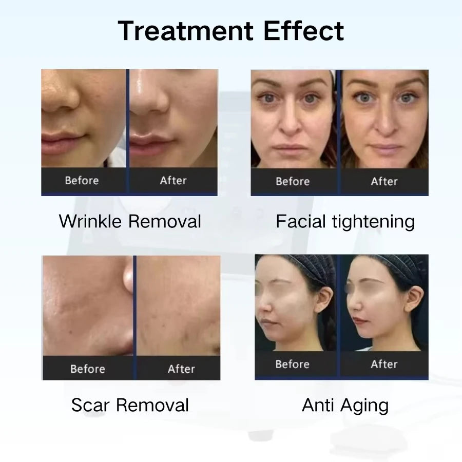 Top-Quality  Thermal Vacuum Micropin Device for Skin Tightening & Face Lifting Facial Wrinkle Removal Machine