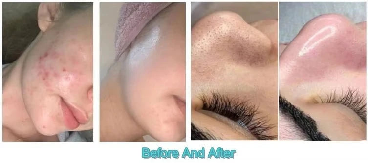 Skin Deep Cleaning 6 in 1 Oxygen Jet Small Bubble Hydrodermobrasion Hydra Skin Care Water Oxygen Jet Peel Machine With Led Mask